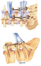 Pedicle Screws