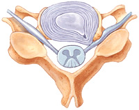 Disc Prolapse