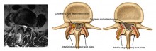 MRI Lumbar Spinal Stenosis - Axial